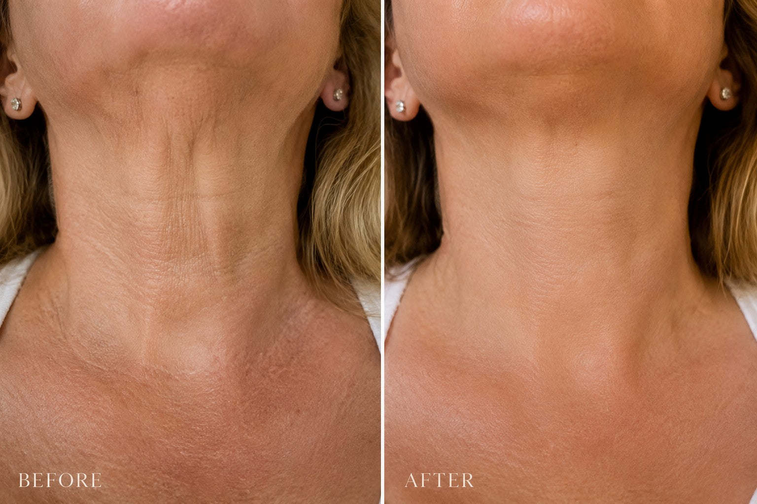 Before and after comparison of neck skin firmness